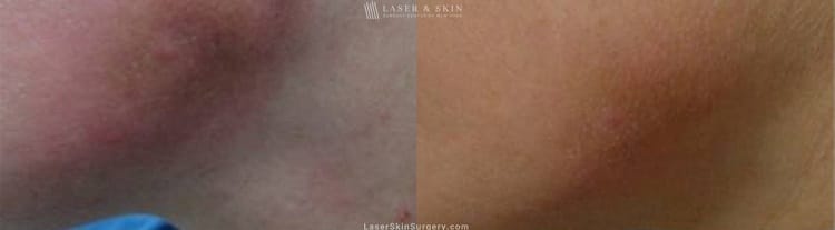 before and after image of a laser treatment for bruising on a woman's chin