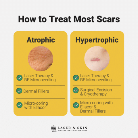 Best treatments for all types of scars explained - Laser NY